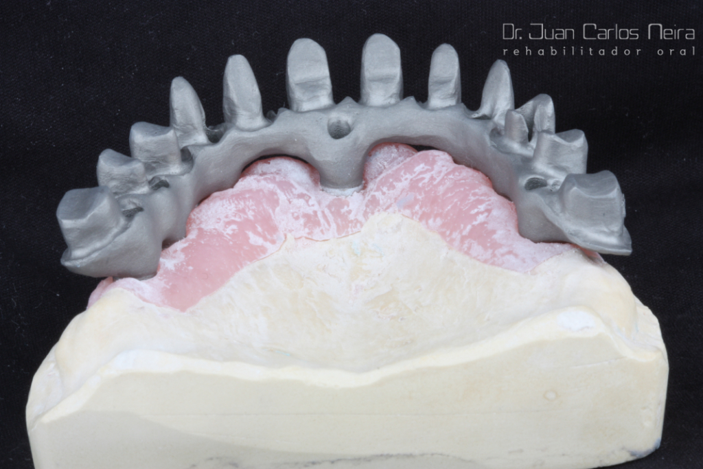 CASO #16 Prótesis Híbrida en Cobalto Cromo CAD-CAM (Phibo) y Cerámica ...
