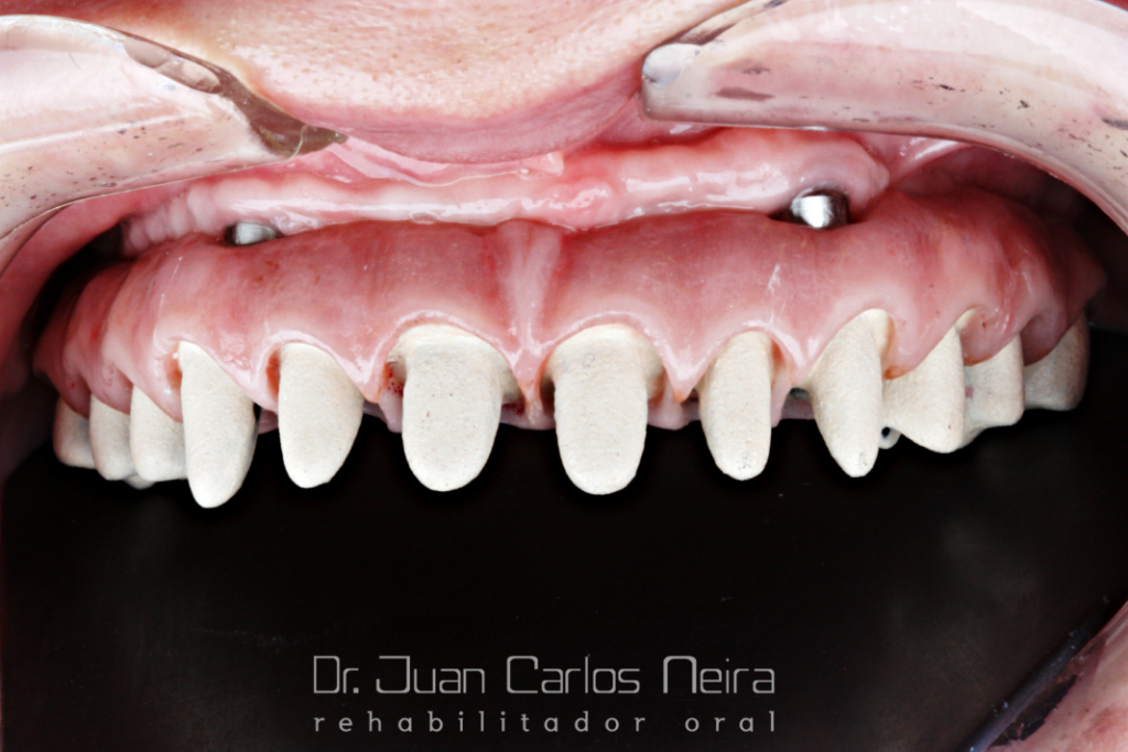 CASO #16 Prótesis Híbrida en Cobalto Cromo CAD-CAM (Phibo) y Cerámica ...